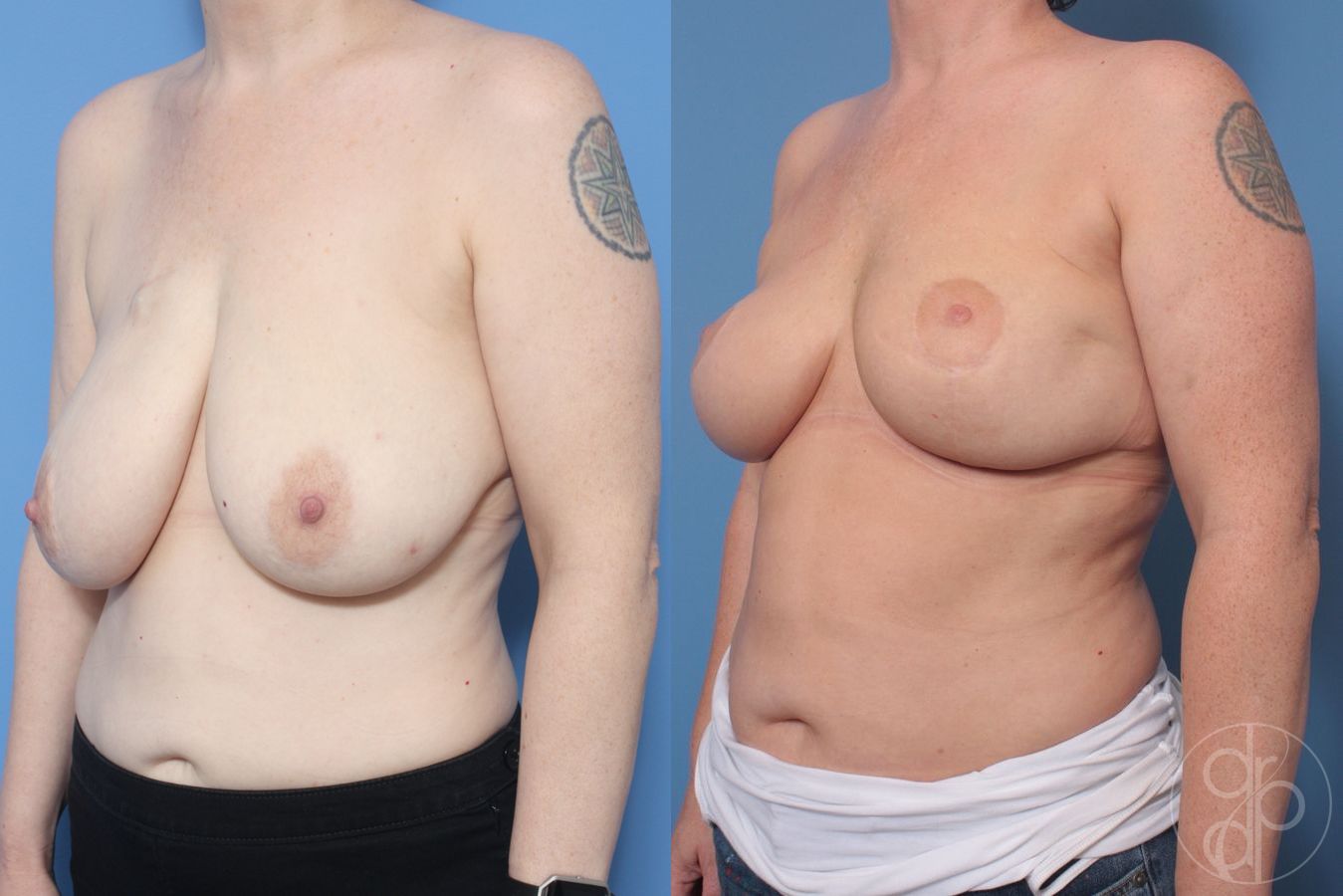 Before and after Breast Reduction case 29871 - Angle 2