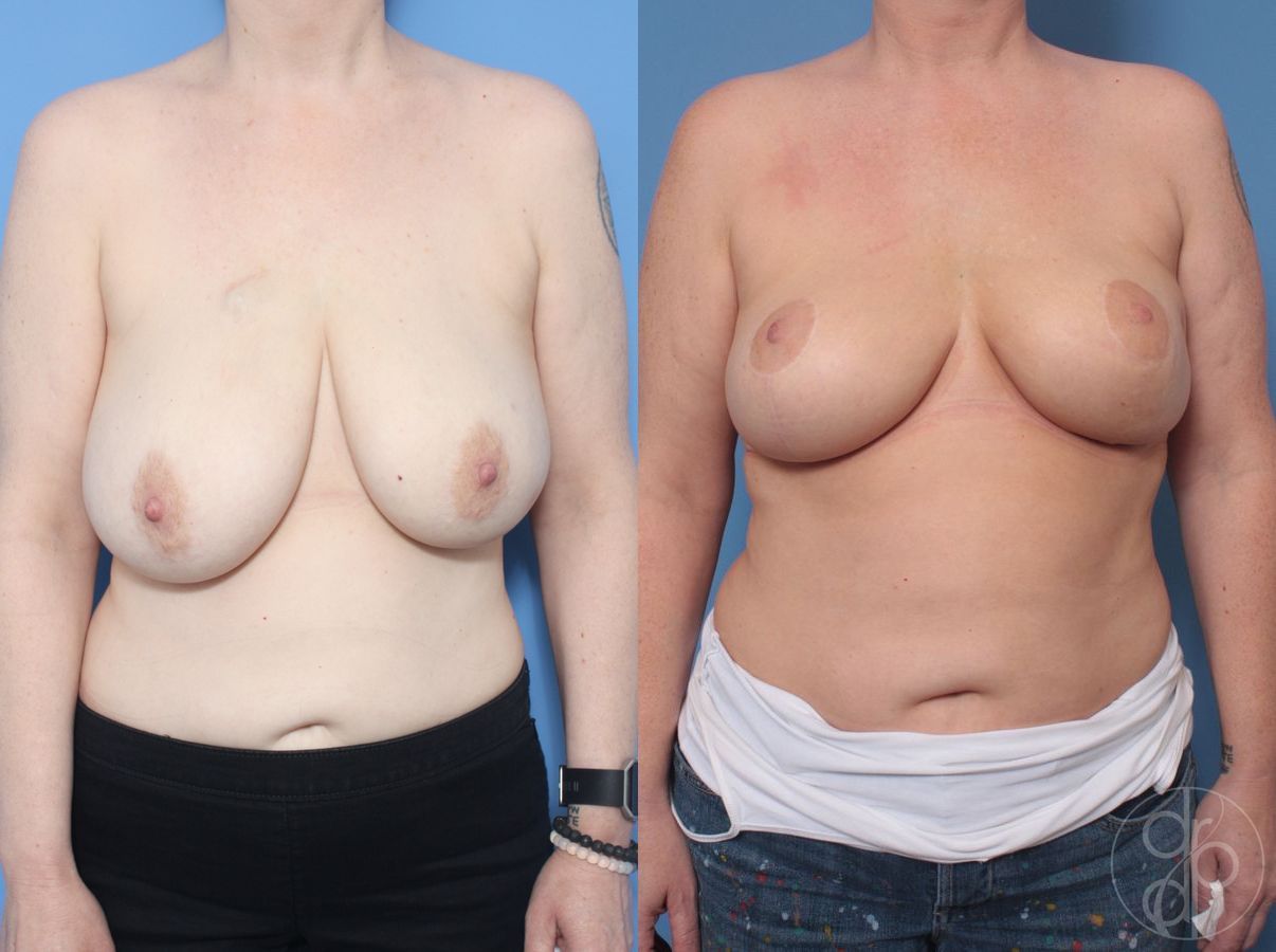 Before and after Breast Reduction case 29871