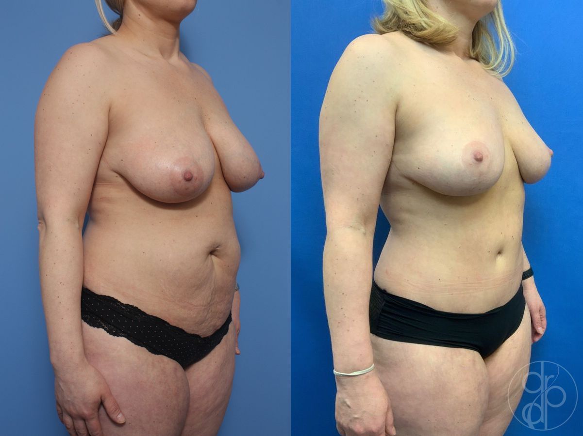 Before and after Breast Reduction case 29702 - Angle 2