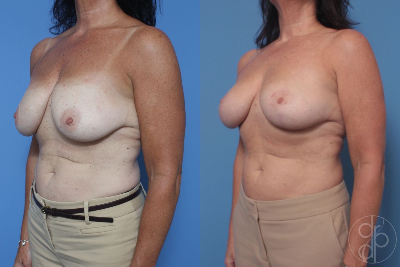 Before and after Breast Reduction case 29849 - Angle 2