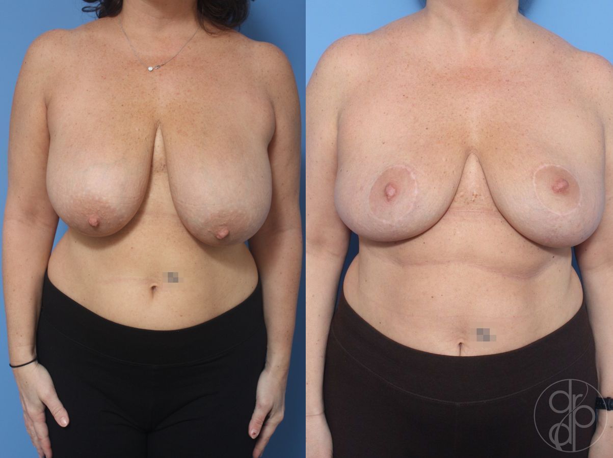 Before and after Breast Reduction case 29855