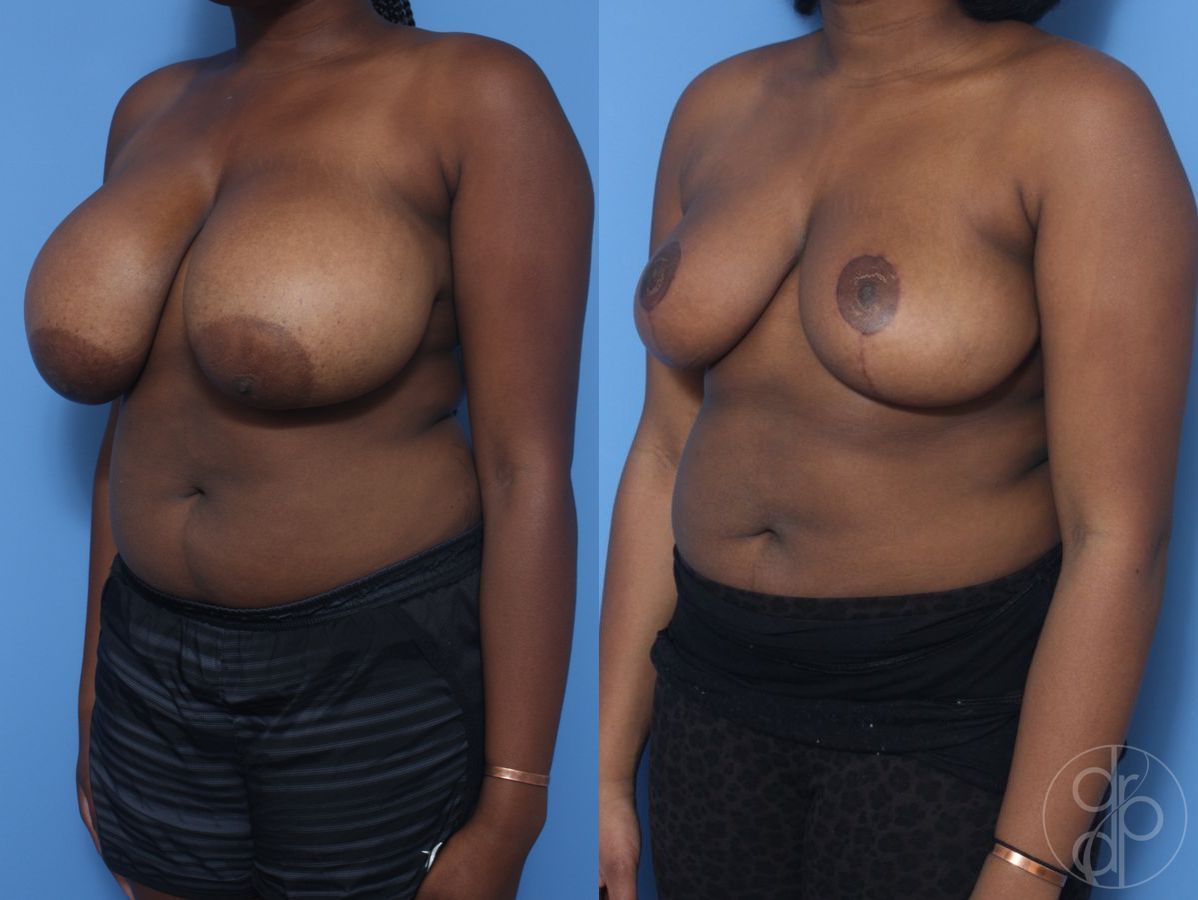 Before and after Breast Reduction case 29850 - Angle 2