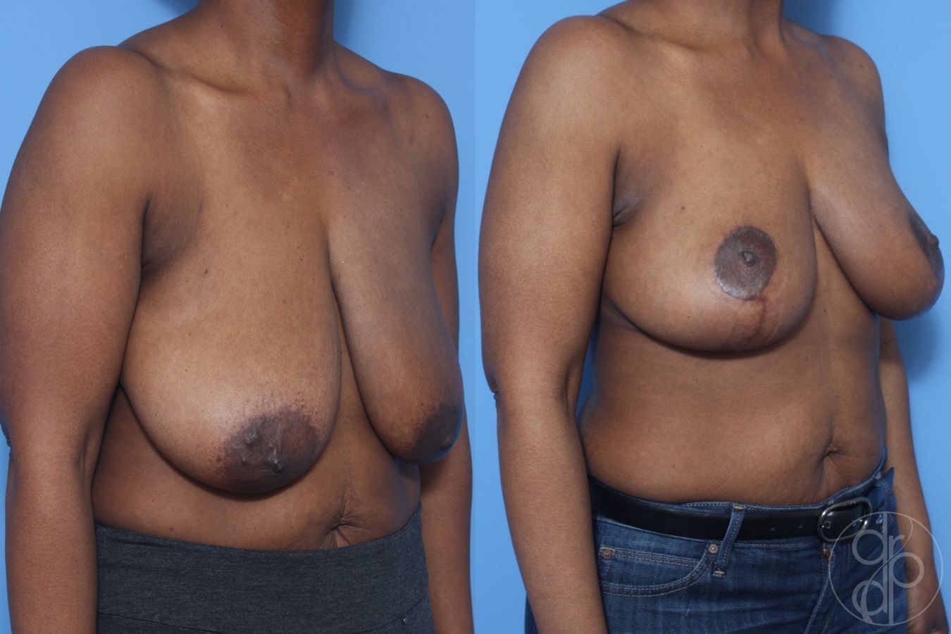 Before and after Breast Reduction case 29853 - Angle 2
