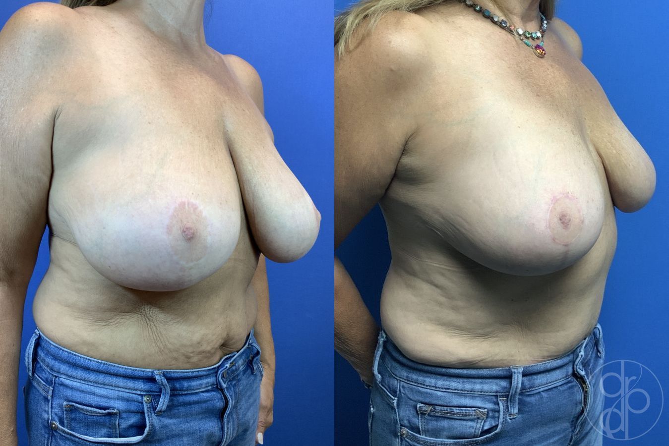 Before and after Breast Reduction case 29881 - Angle 3