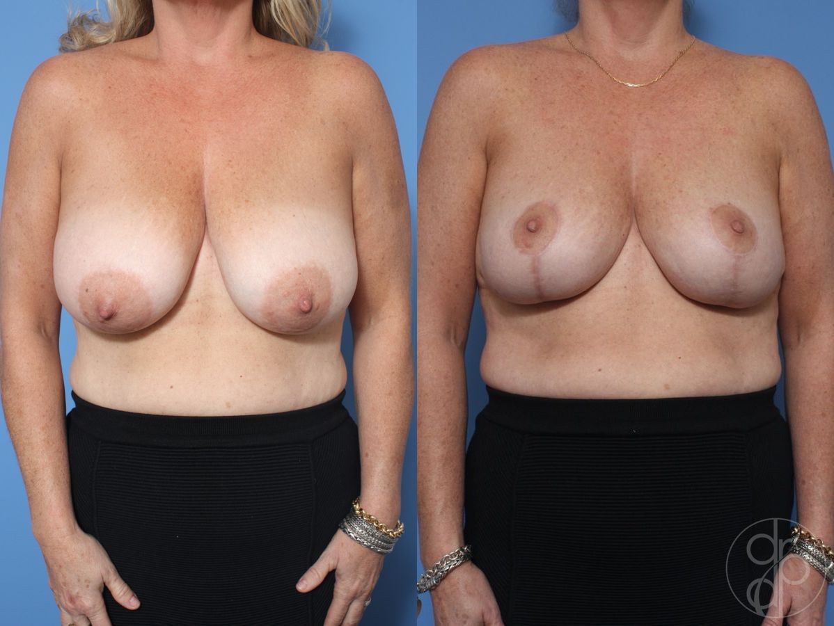 Before and after Breast Reduction case 29854