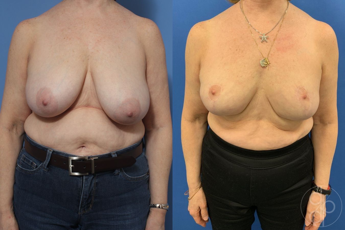 Before and after Breast Reduction case 29845
