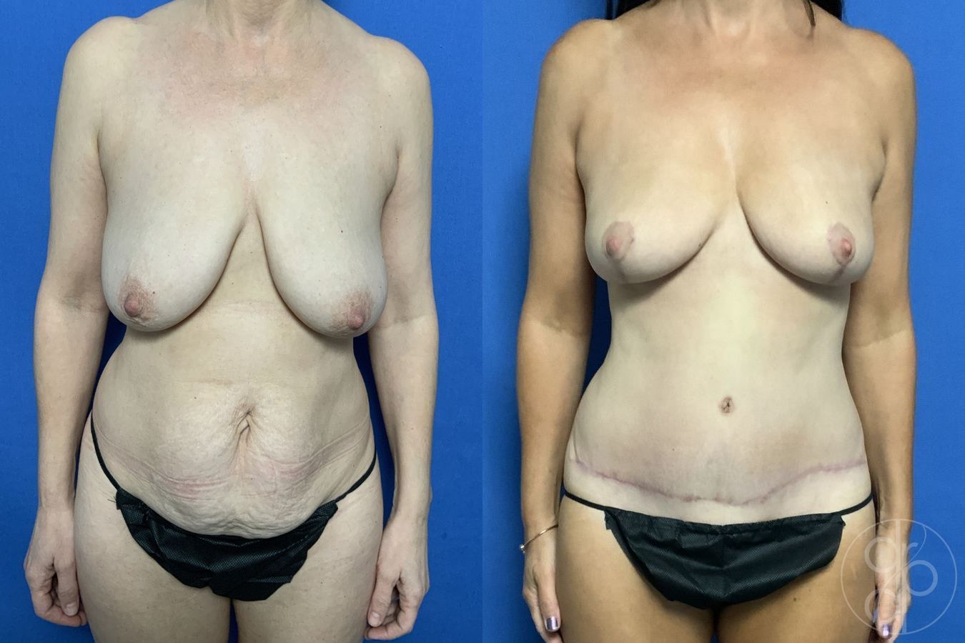 Before and after Mommy Makeover case 29714