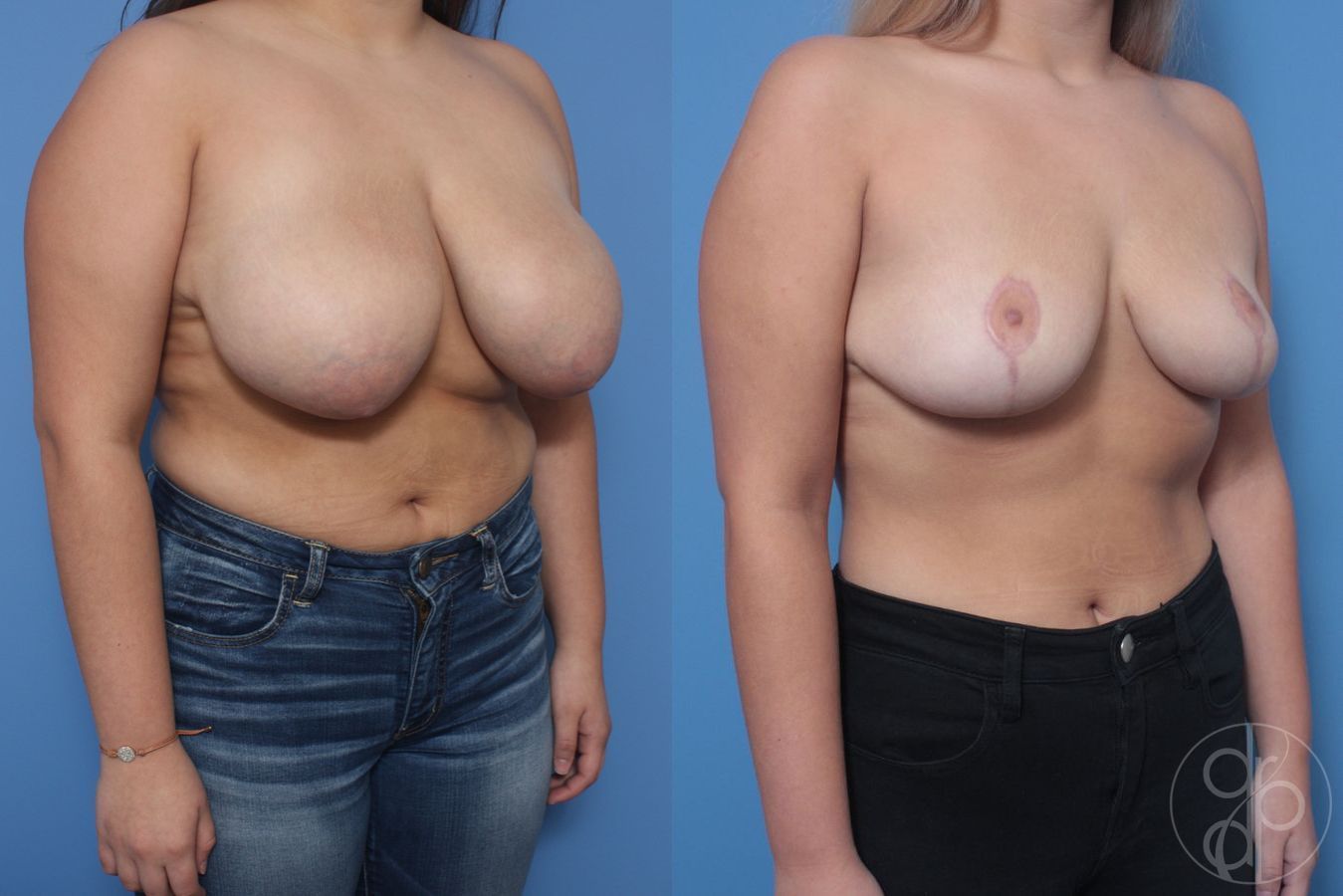 Before and after Breast Reduction case 29847 - Angle 2