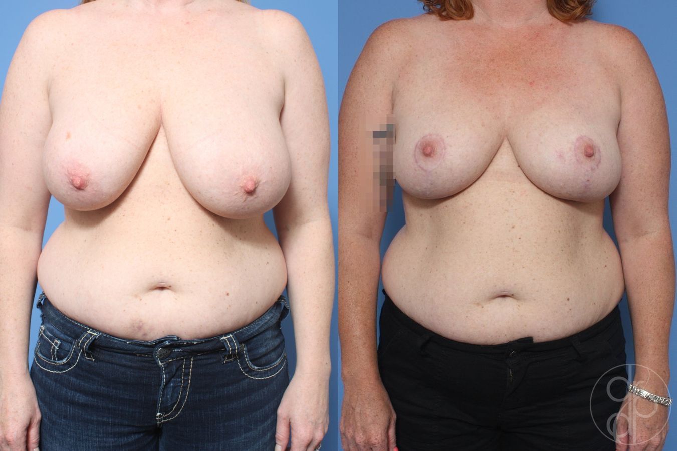 Before and after Breast Reduction case 29858