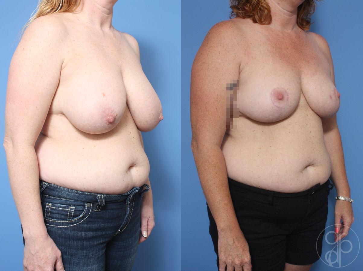 Before and after Breast Reduction case 29858 - Angle 3