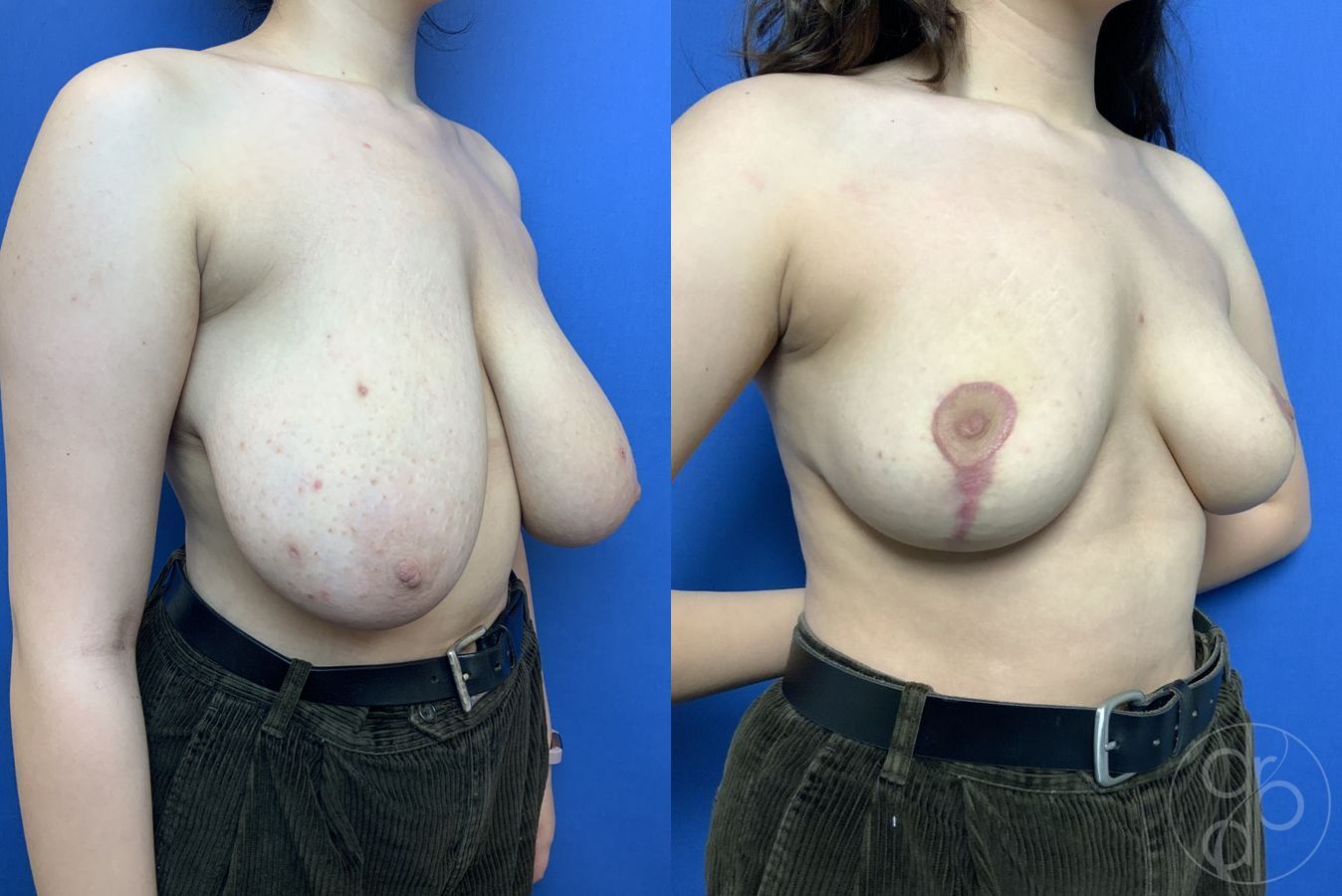 Before and after Breast Reduction case 29880 - Angle 3