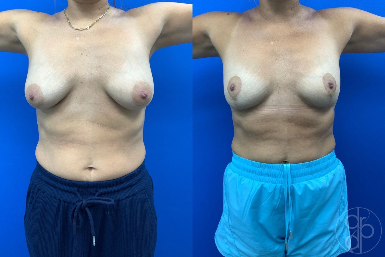 Before and after Breast Reduction case 43459 - Angle 2