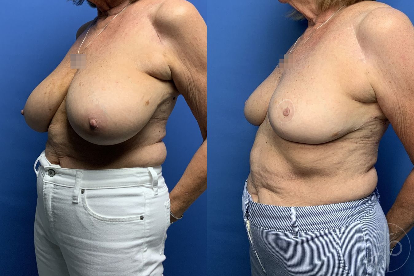 Before and after Breast Reduction case 29883 - Angle 3