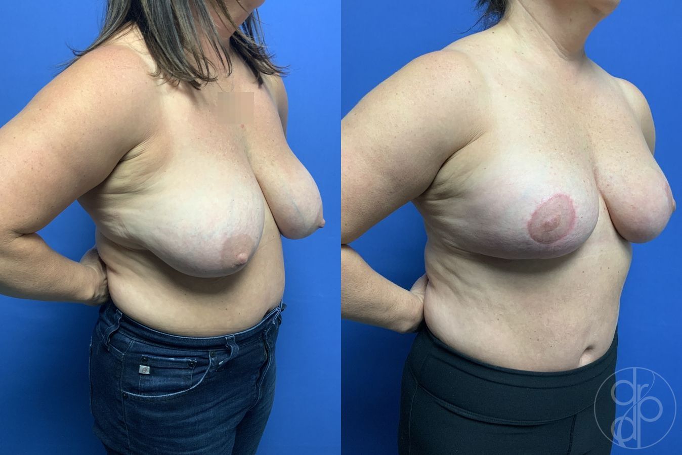 Before and after Breast Reduction case 29901 - Angle 2