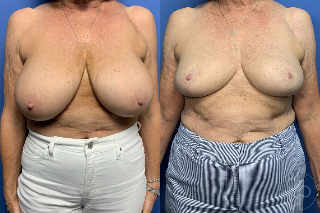Before and after Breast Reduction case 29883