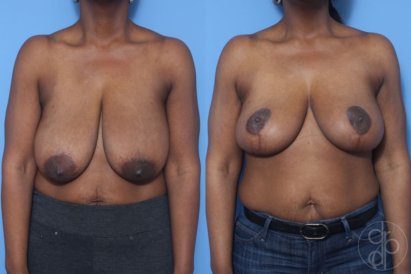 Before and after Breast Reduction case 29853
