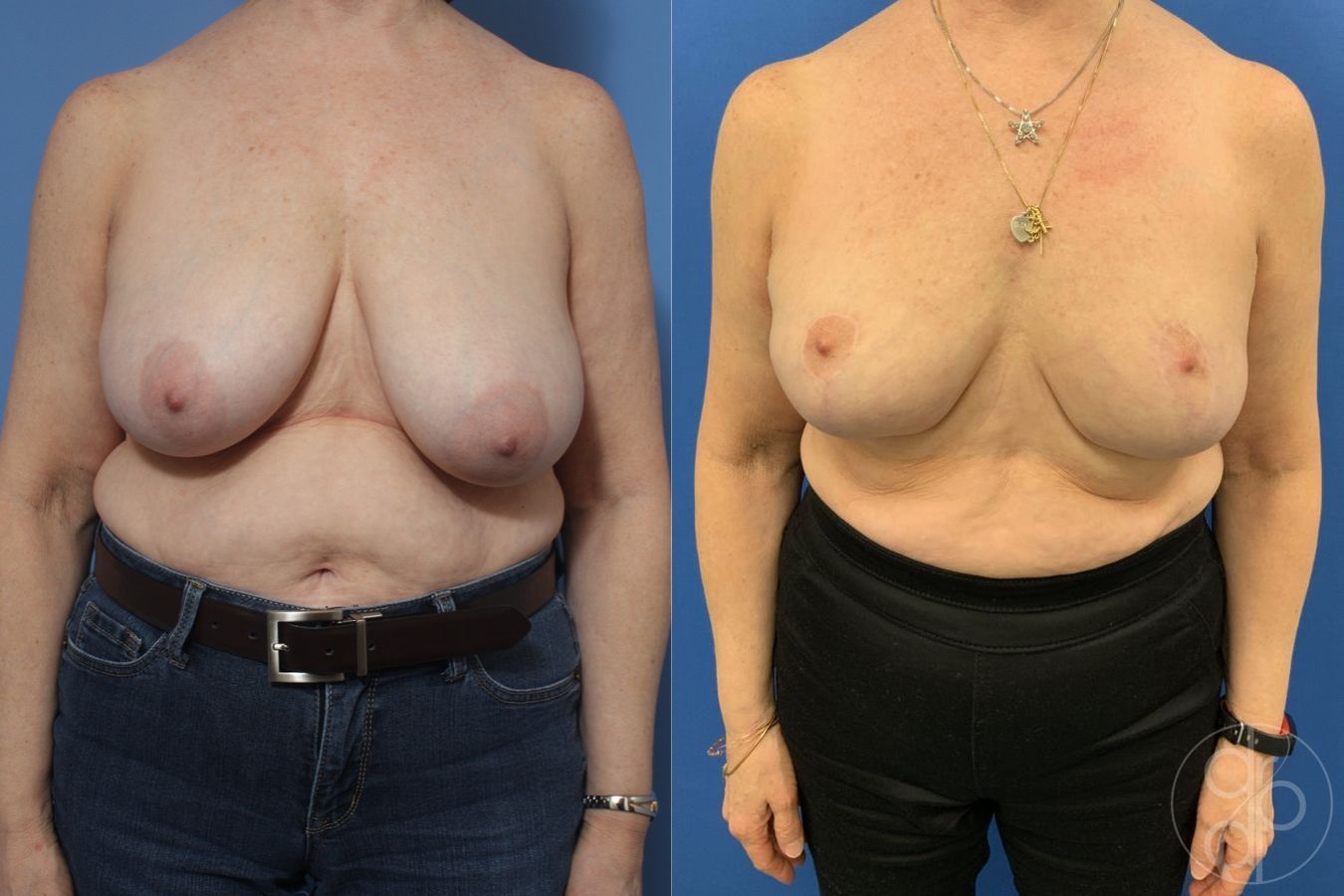 Before and after Breast Reduction case 29845