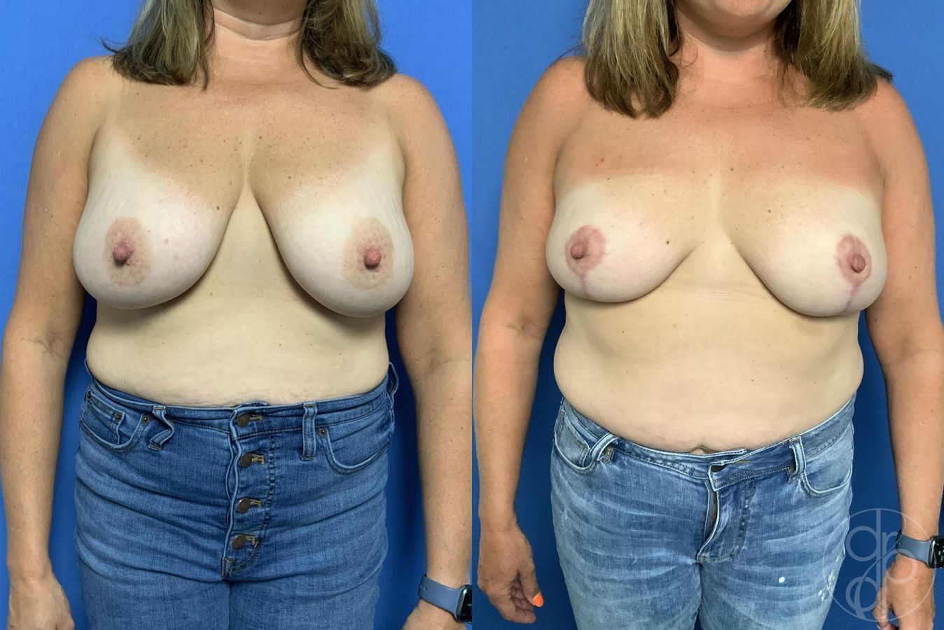 Before and after Breast Reduction case 29631