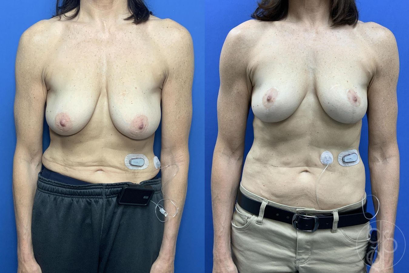 Before and after Breast Reduction case 29646