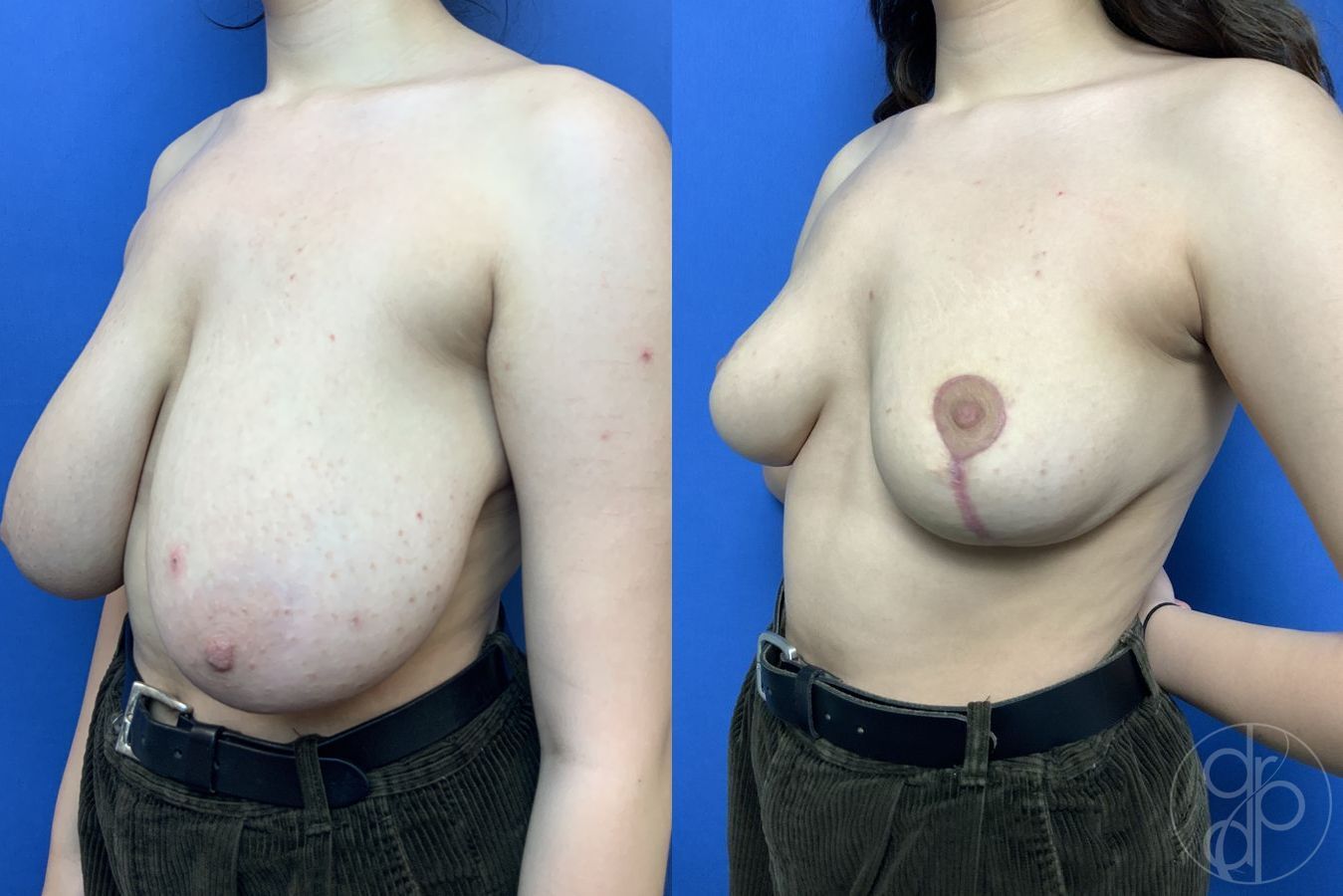 Before and after Breast Reduction case 29880 - Angle 2