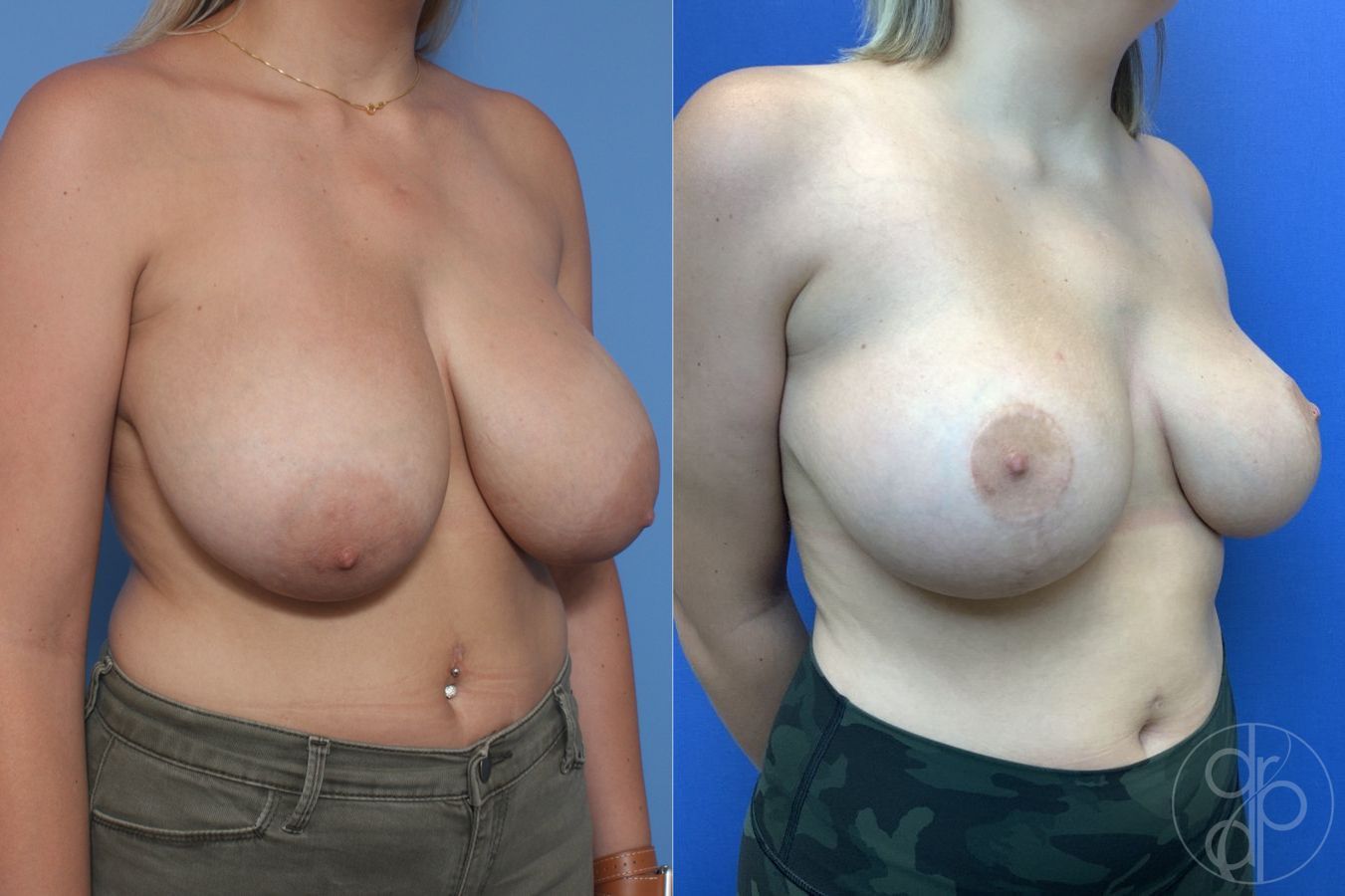 Before and after Breast Reduction case 29856 - Angle 2