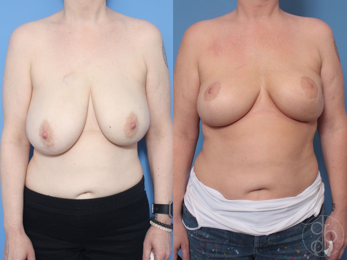 Before and after Breast Reduction case 29871