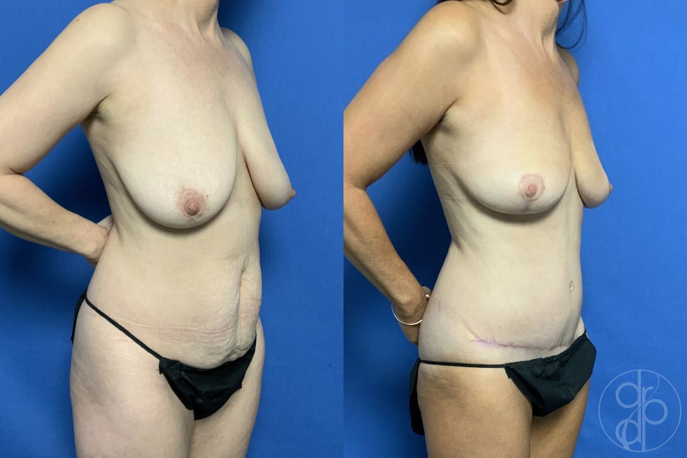 Before and after Breast Reduction case 29714 - Angle 2