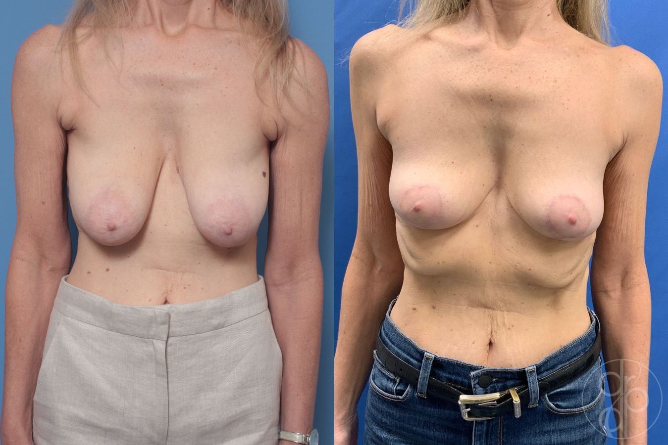 Before and after Breast Reduction case 29876