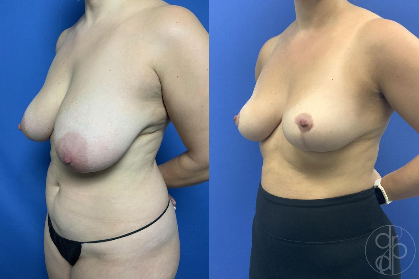 Before and after Breast Reduction case 29968 - Angle 3
