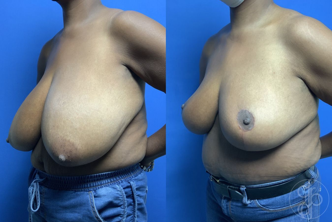 Before and after Breast Reduction case 29879 - Angle 3