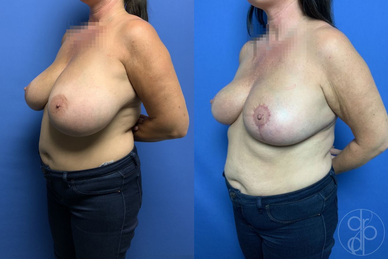 Before and after Breast Reduction case 29835 - Angle 2