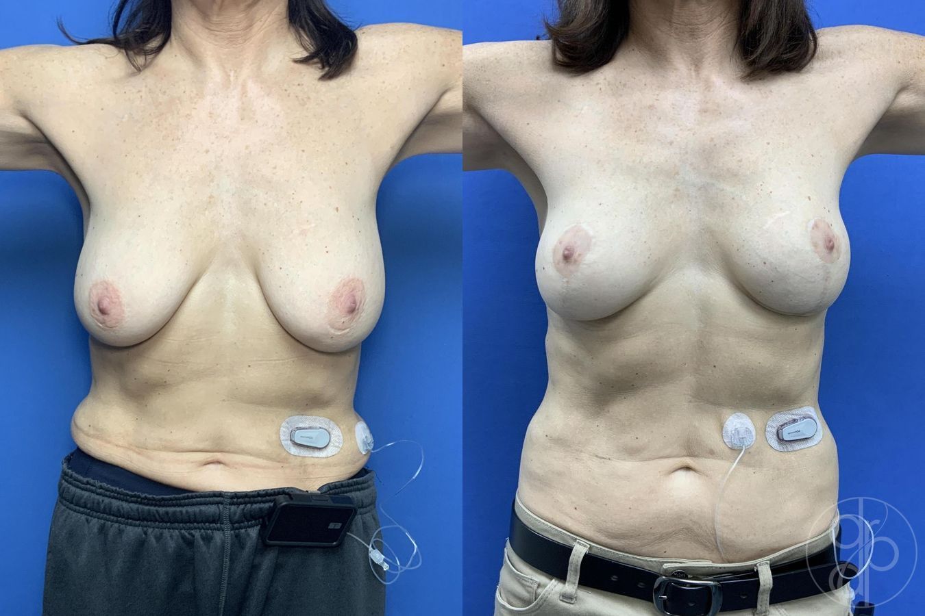 Before and after Breast Reduction case 29646 - Angle 2