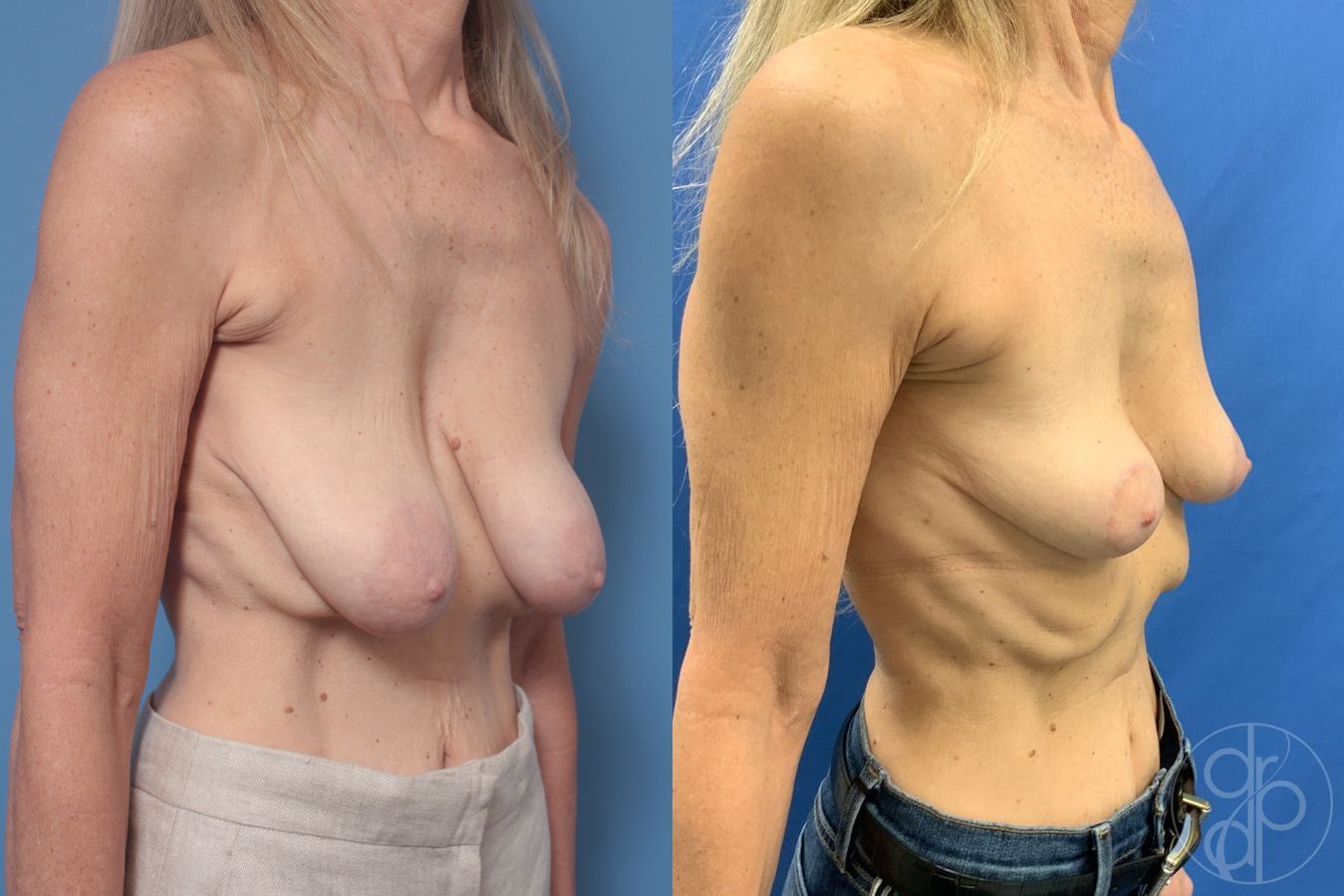 Before and after Breast Reduction case 29876 - Angle 3