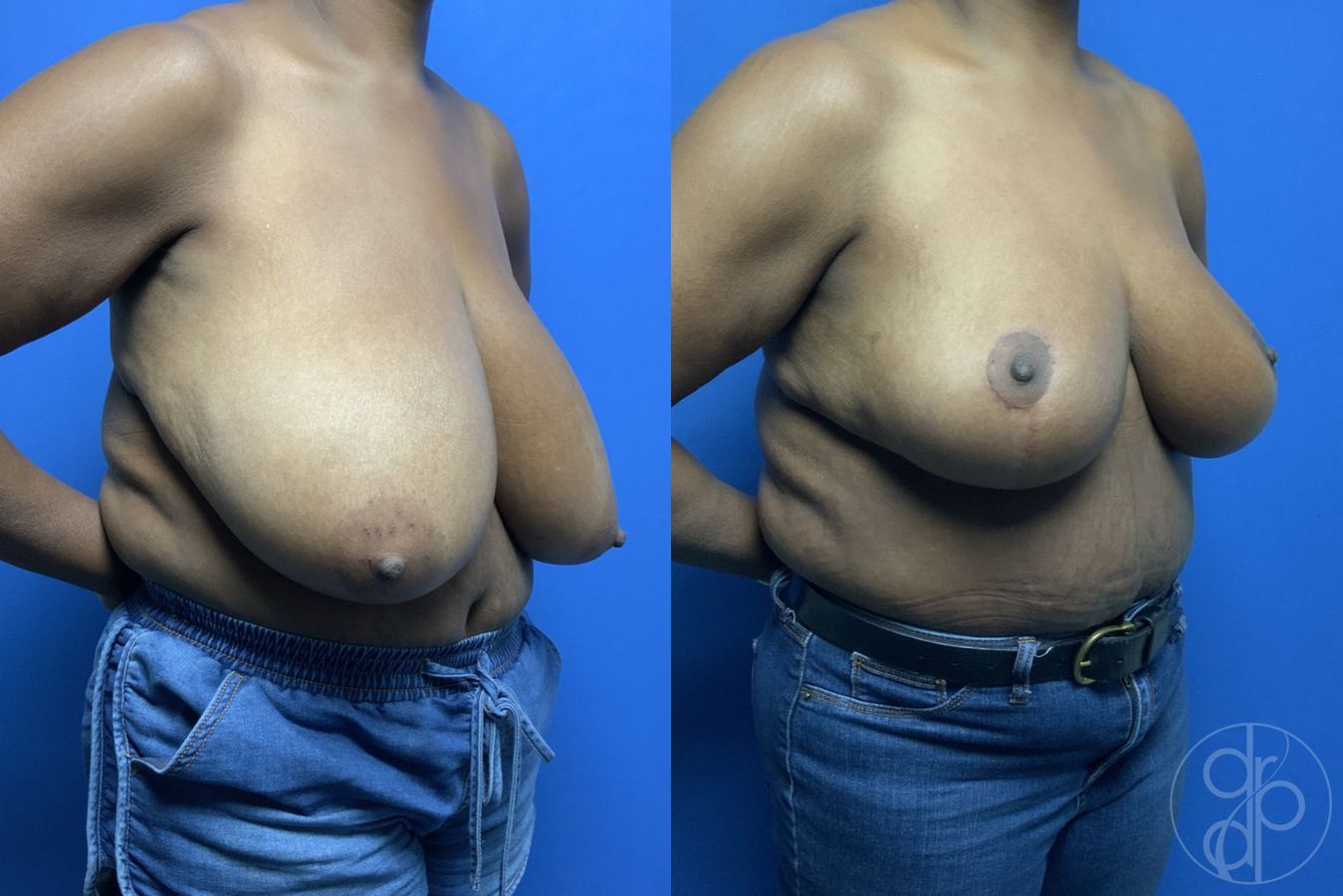 Before and after Breast Reduction case 29879 - Angle 2