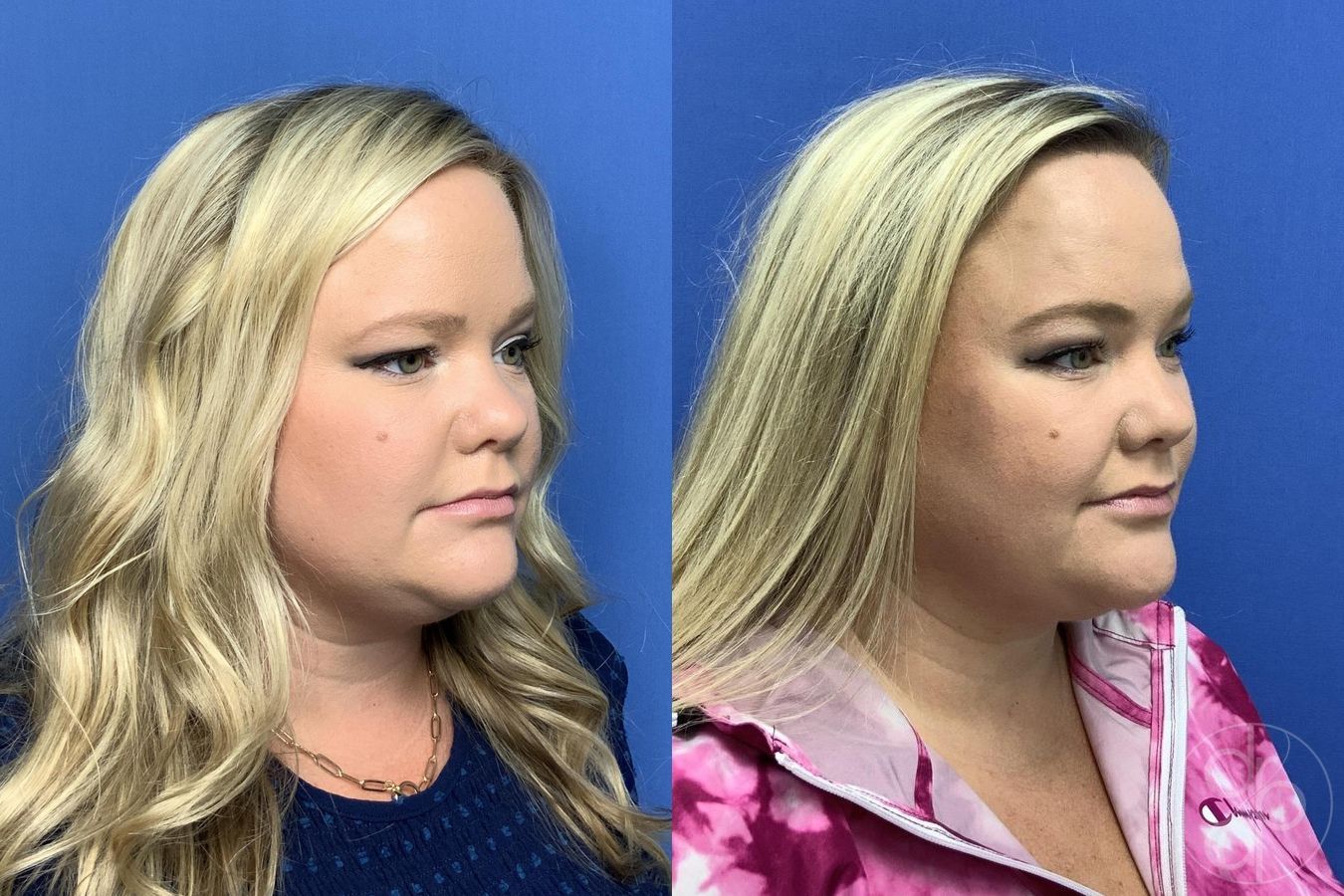Before and after Brow Lift case 29996 - Angle 2