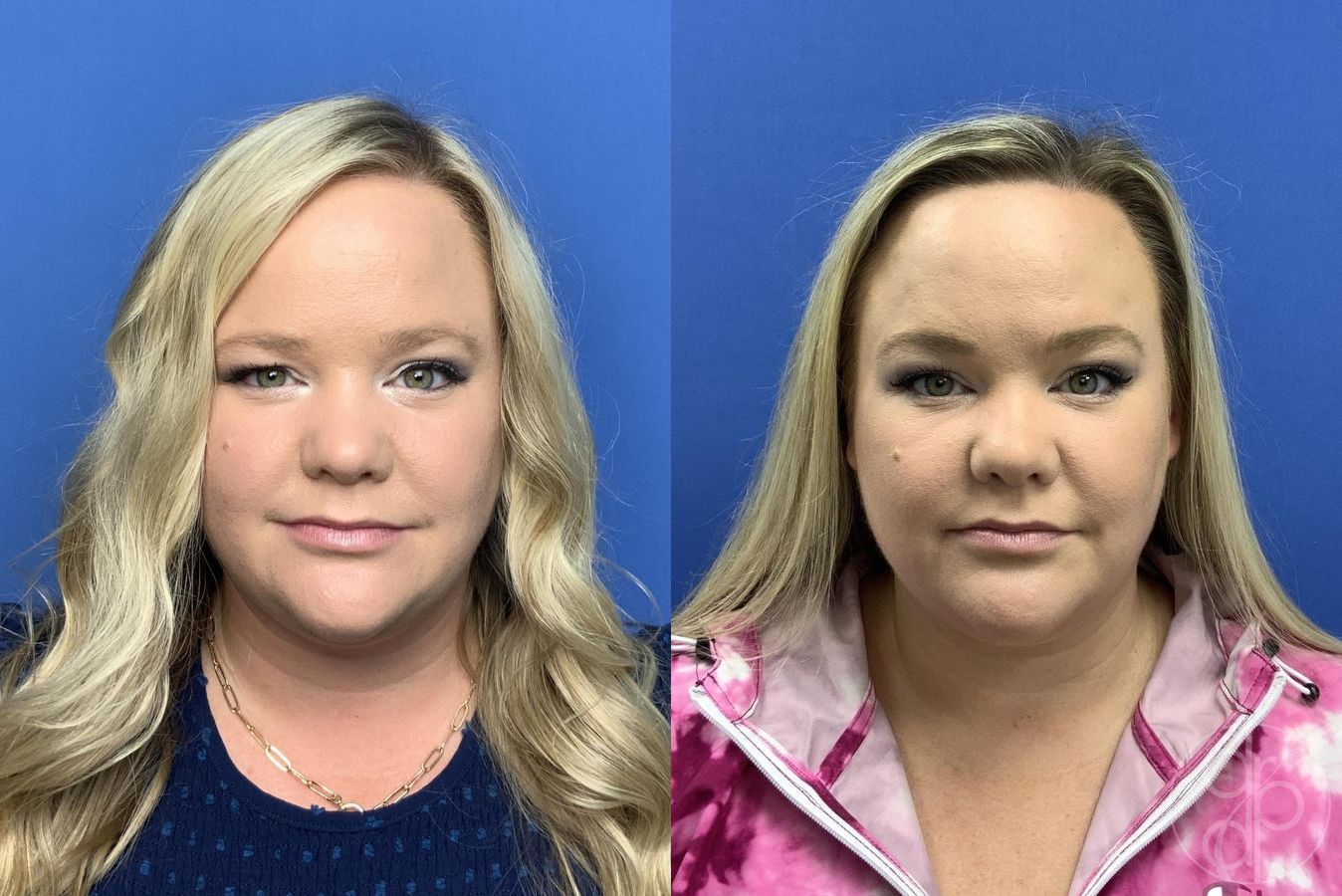 Before and after Brow Lift case 29996