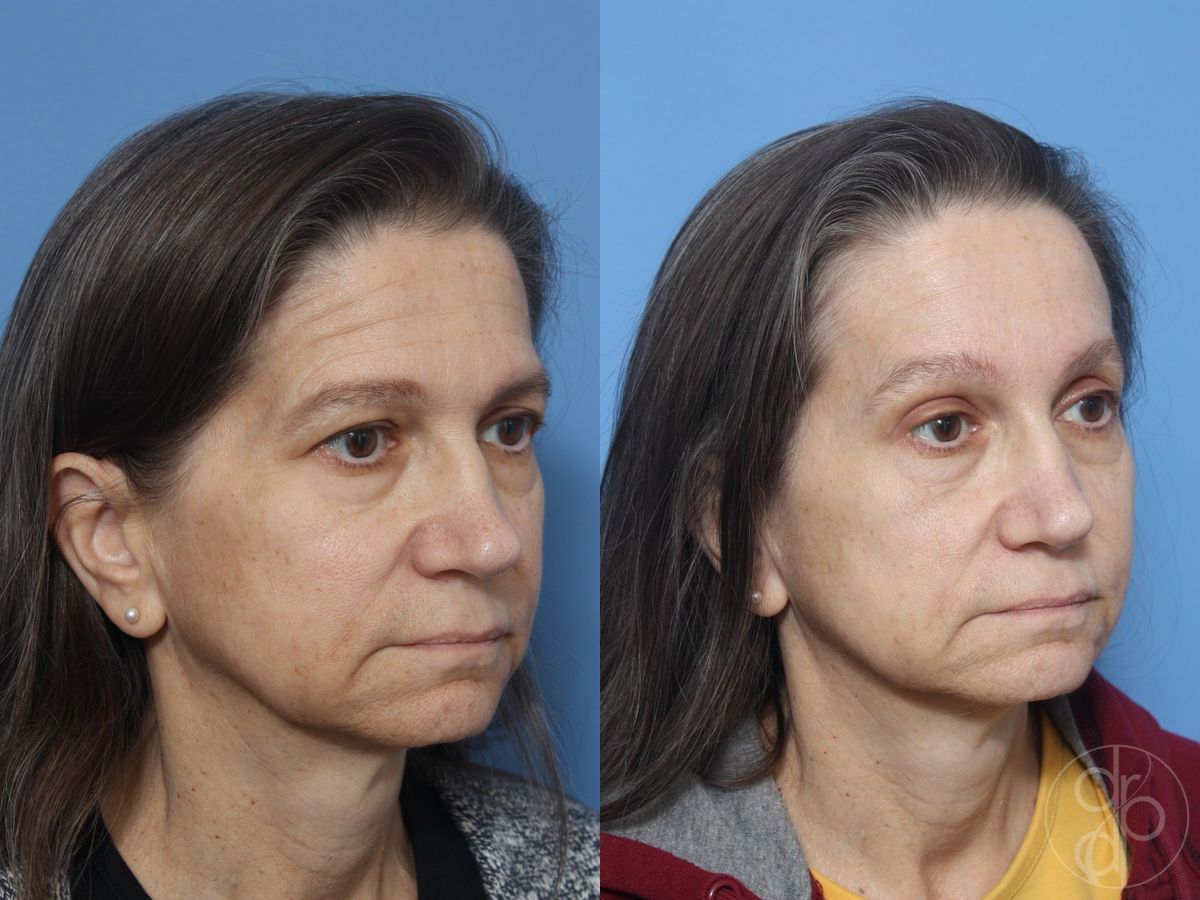 Before and after Blepharoplasty case 29808 - Angle 2