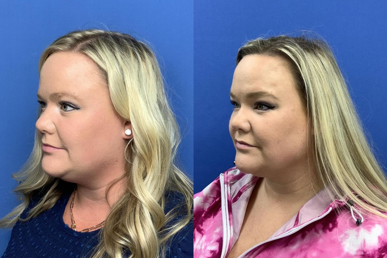 Before and after Brow Lift case 29996 - Angle 3