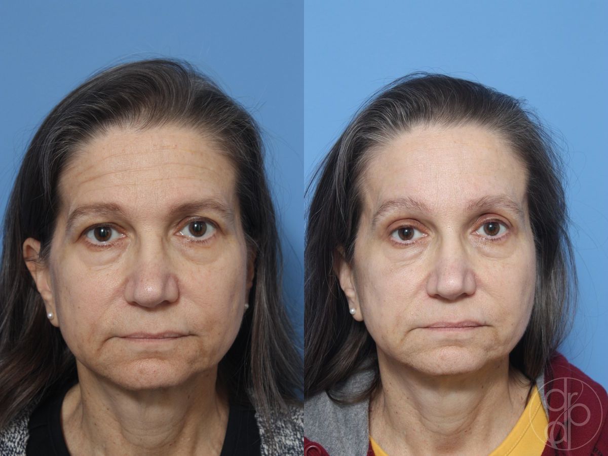 Before and after Blepharoplasty case 29808