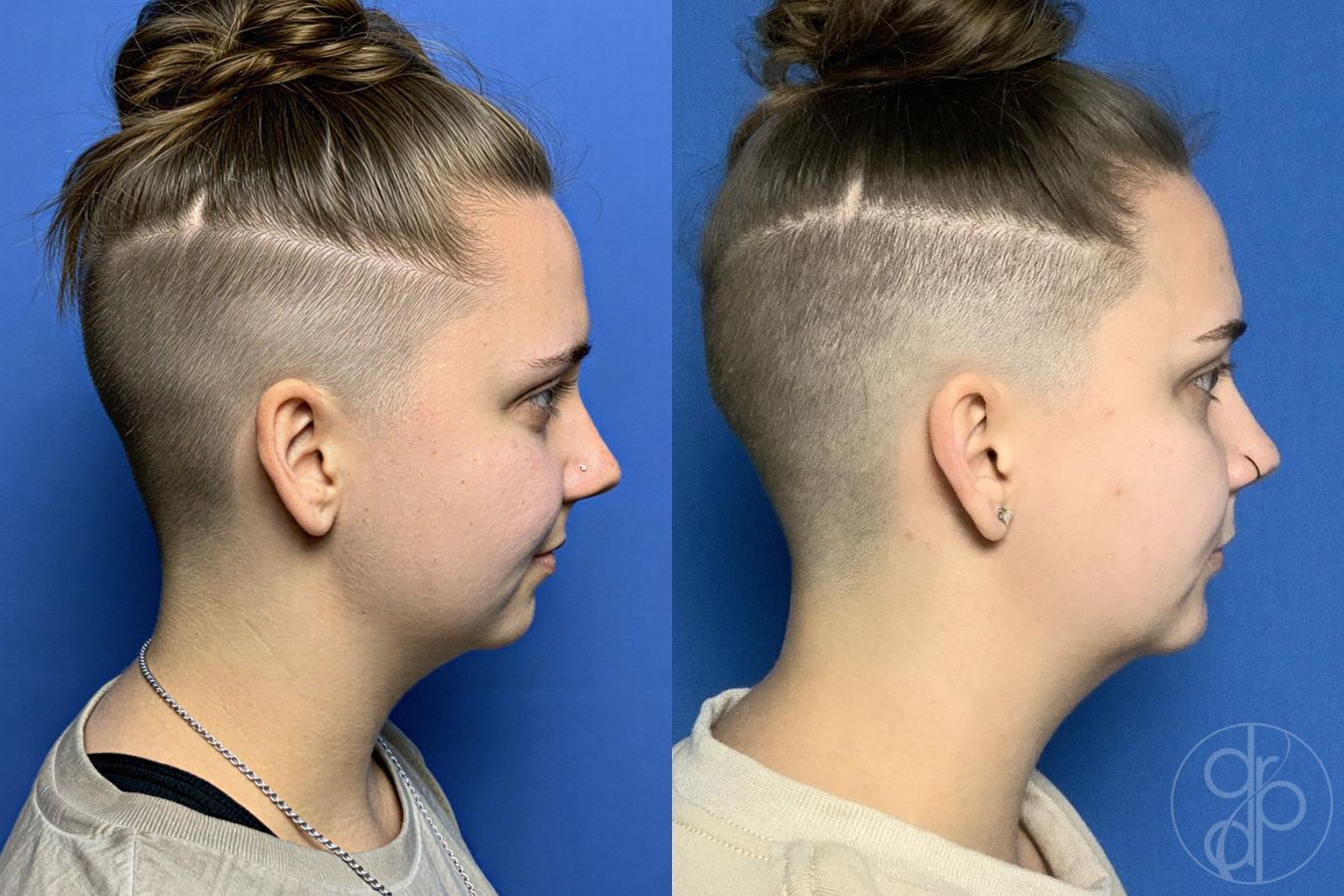 Before and after Chin Augmentation case 29803 - Angle 3
