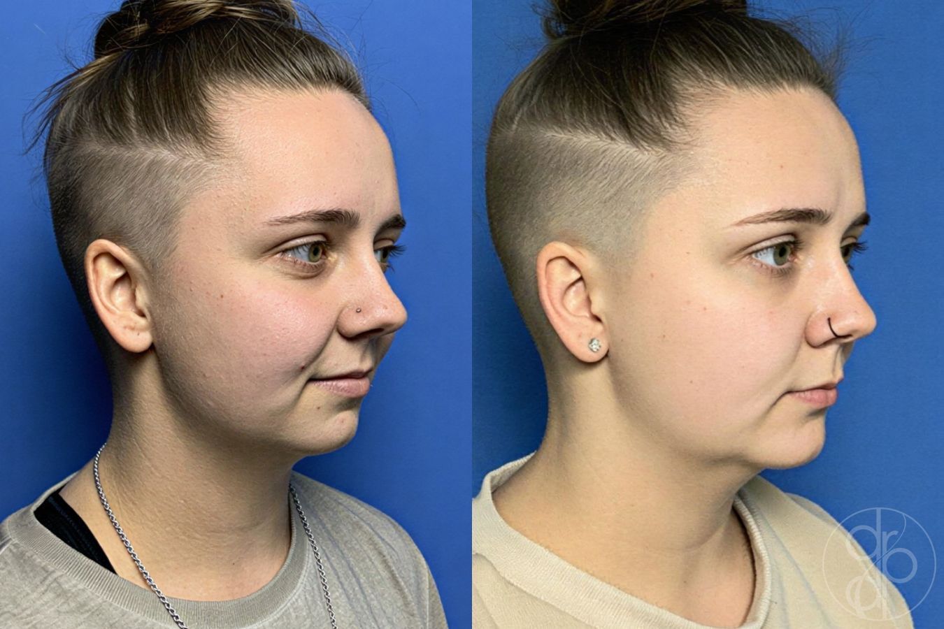 Before and after Chin Augmentation case 29803 - Angle 2
