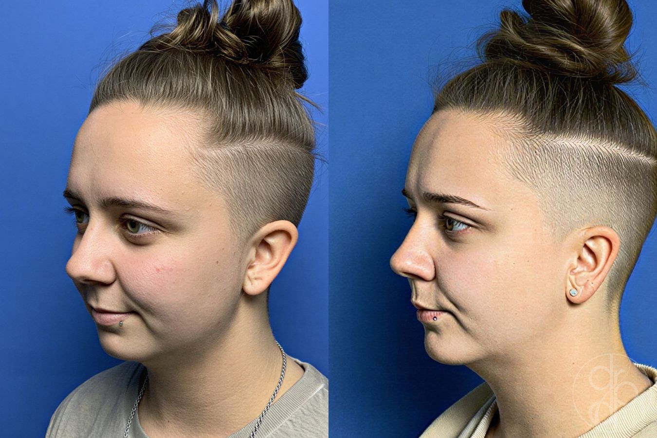 Before and after Chin Augmentation case 29803 - Angle 4