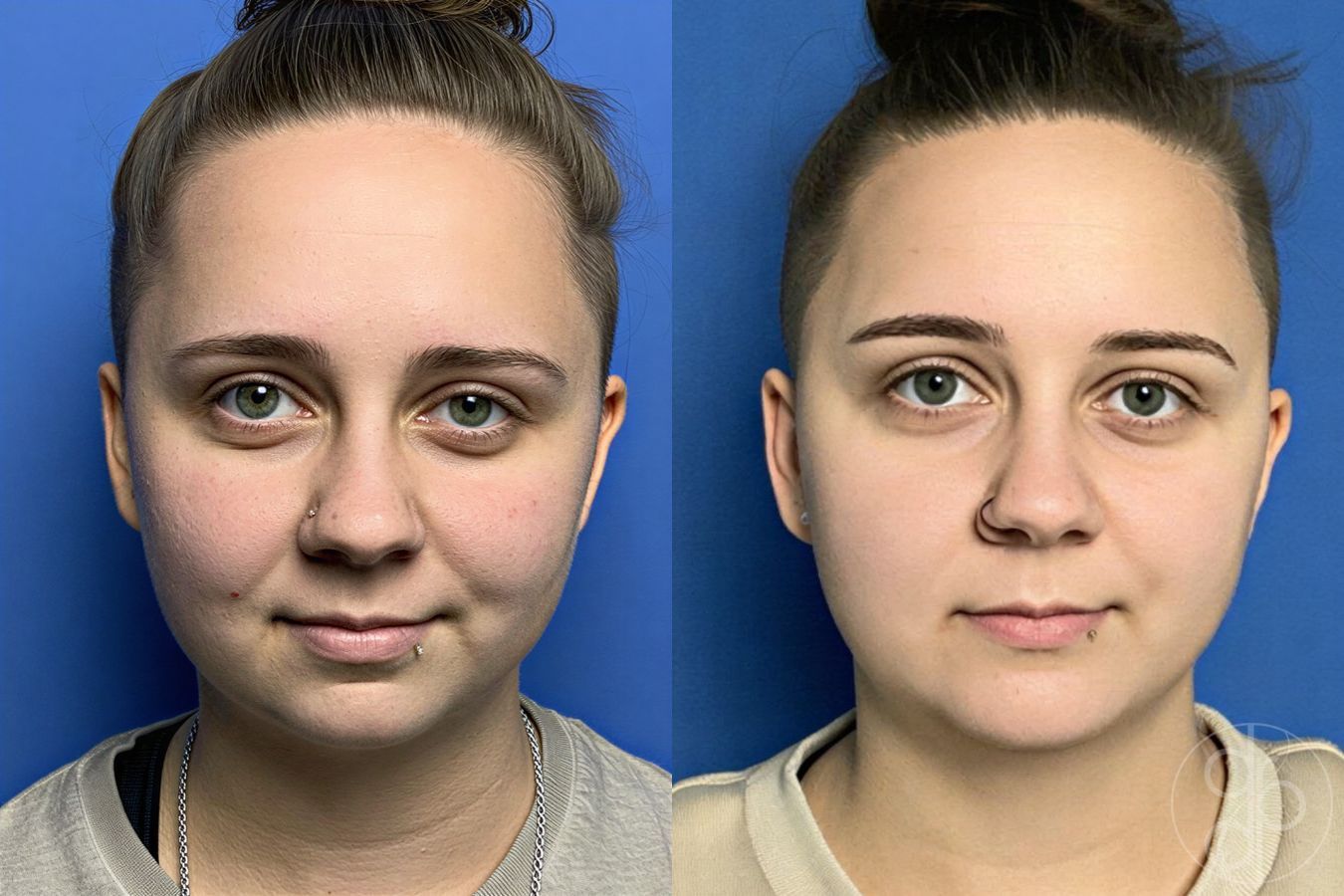 Before and after Chin Augmentation case 29803