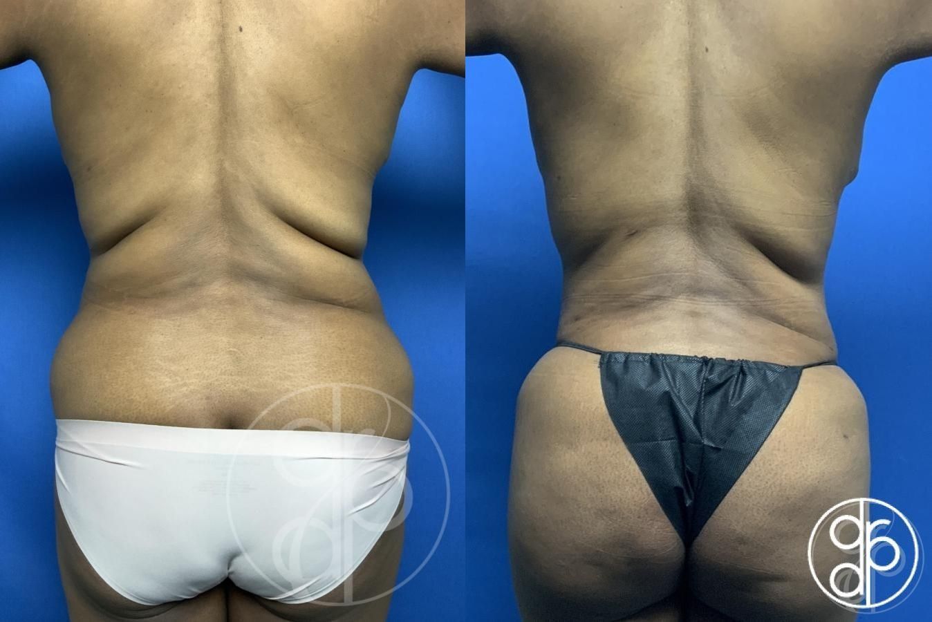 Combo Procedures - Body - Thumbnail 2