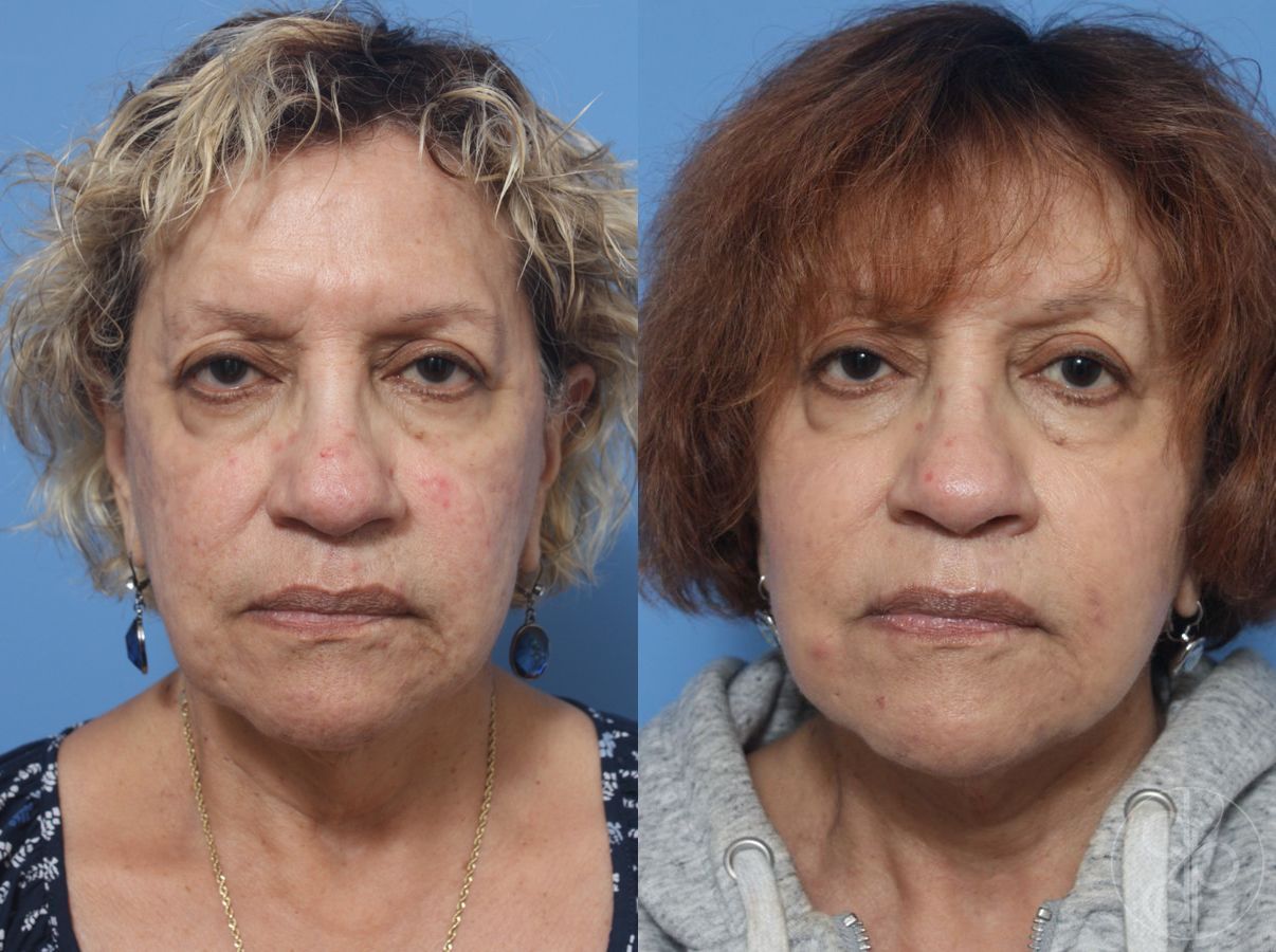 Before and after Facelift case 29842