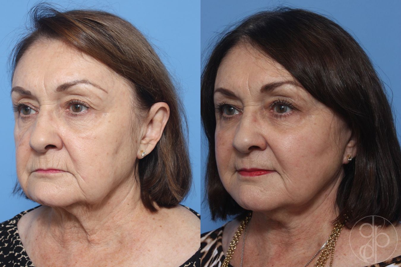 Before and after Facelift case 29843 - Angle 2