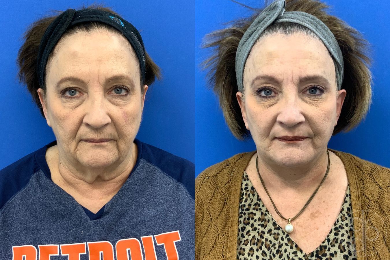 Before and after Facelift case 43472