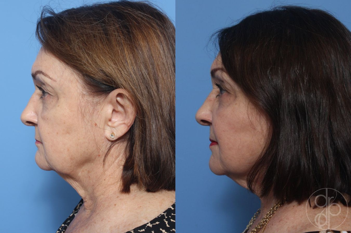Before and after Facelift case 29843 - Angle 5