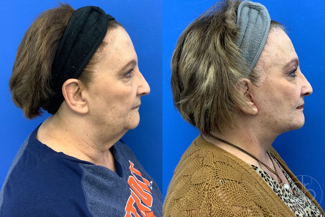 Before and after Facelift case 43472 - Angle 6