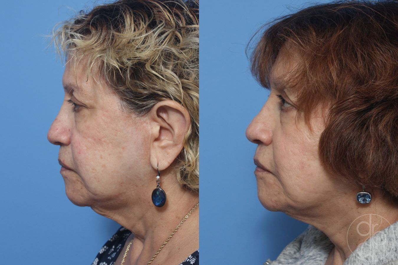 Before and after Facelift case 29842 - Angle 2